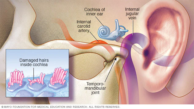 tinnitus